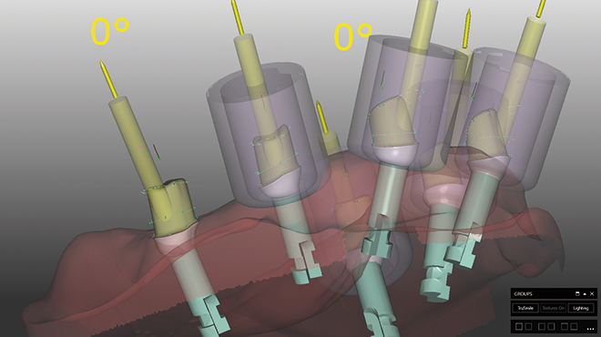 Případy nevýhodně zavedených implantátů: inovativní řešení