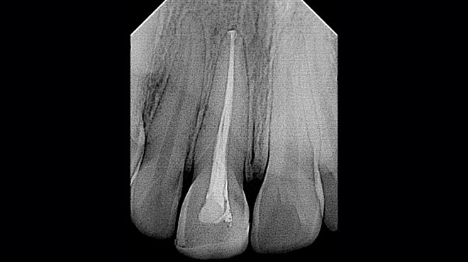 Akutní apikální periodontitida u horního pravého středního řezáku, obturovaná pomocí BioRoot RCS