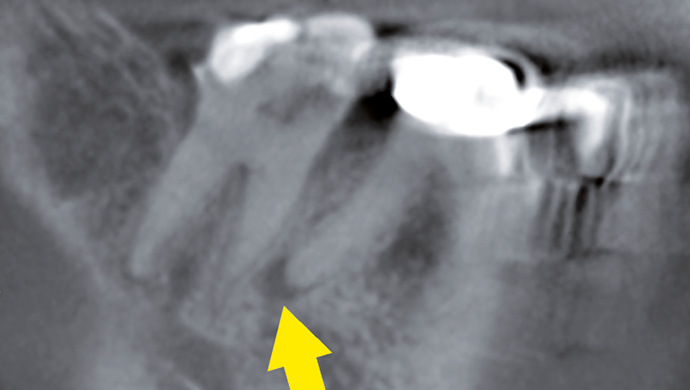 Endodoncie ve 3D – kazuistika s využitím CBCT Endodoncie ve 3D – kazuistika s využitím CBCT