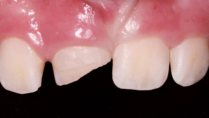 Endodontické ošetření horního středního řezáku s atypickou anatomií Endodontické ošetření horního středního řezáku s atypickou anatomií
