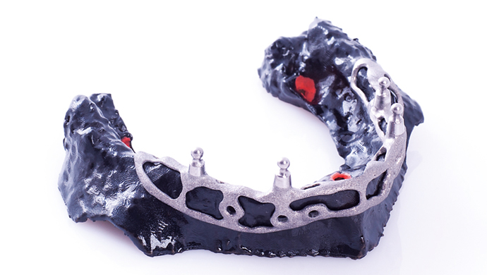 Fixovaný CAD/CAM subperiosteální implantát Fixovaný CAD/CAM subperiosteální implantát