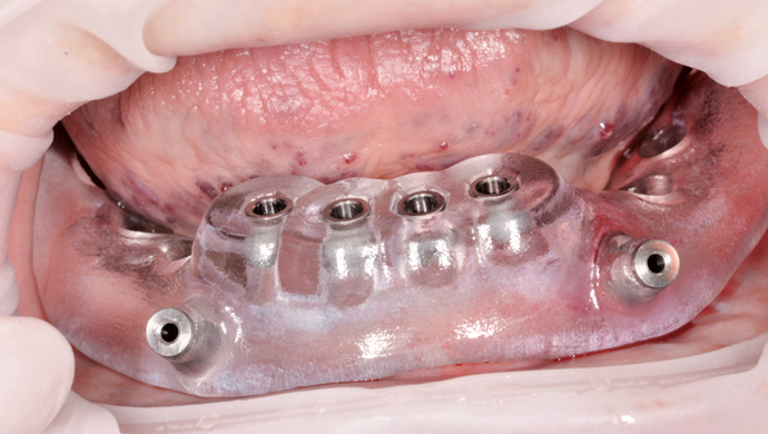 Trojrozměrné plánování a šablonou navigované zavedení miniimplantátů s okamžitým zatížením Trojrozměrné plánování a šablonou navigované zavedení miniimplantátů s okamžitým zatížením