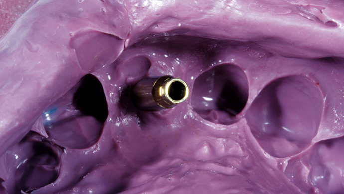 Náhrada frontálního zubu implantátem a korunkou 1. část: Optimální vytvarování měkkých tkání Náhrada frontálního zubu implantátem a korunkou 1. část: Optimální vytvarování měkkých tkání