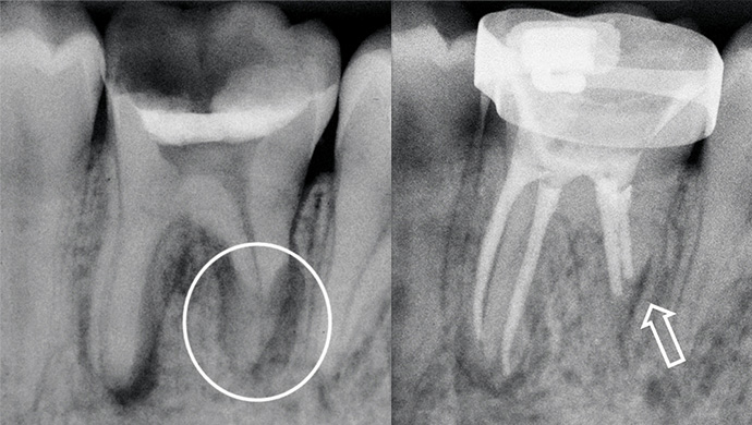 Endodontické ošetření zubu s nekrózou pulpy a rozsáhlou zánětlivou vnější apikální resorpcí v jedné návštěvě: Je to možné? Endodontické ošetření zubu s nekrózou pulpy a rozsáhlou zánětlivou vnější apikální resorpcí v jedné návštěvě: Je to možné?