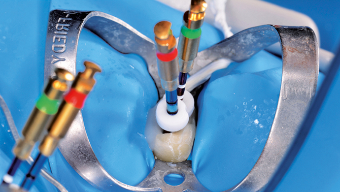Klinické použití vysoce flexibilních nástrojů pro běžnou i složitější endodonciiNové endodontické nástroje Unicone PLUS Klinické použití vysoce flexibilních nástrojů pro běžnou i složitější endodonciiNové endodontické nástroje Unicone PLUS