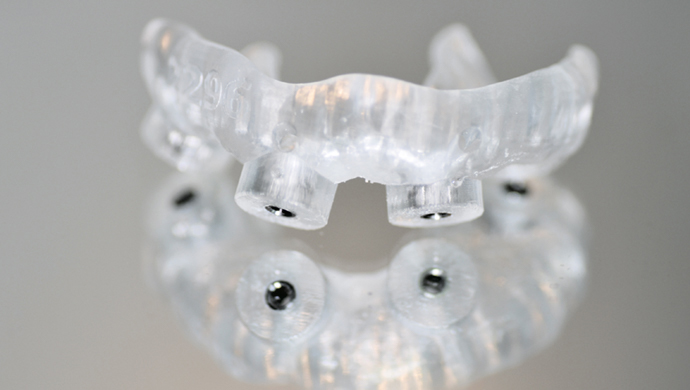 Implantáty a já – seznámení s oseointegrací Implantáty a já – seznámení s oseointegrací