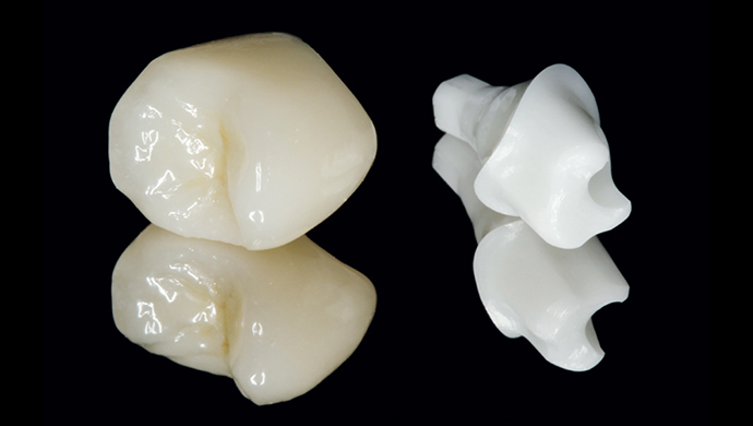 CAD/CAM abutment a korunka v jediném kroku CAD/CAM abutment a korunka v jediném kroku
