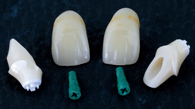 Celokeramické implantáty ve frontálním úseku s těžkým poškozením parodontu