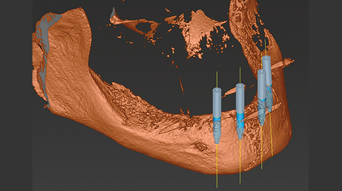 CBCT navigované zavedení miniimplantátů s okamžitým zatížením