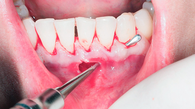 Chirurgická léčba gingiválních recesů u ortodontického pacienta