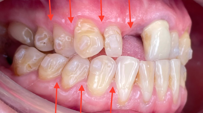 Použití plazmy bohaté na trombocyty v ortodoncii s využitím platformy Dental Monitoring v rámci klinické kontroly