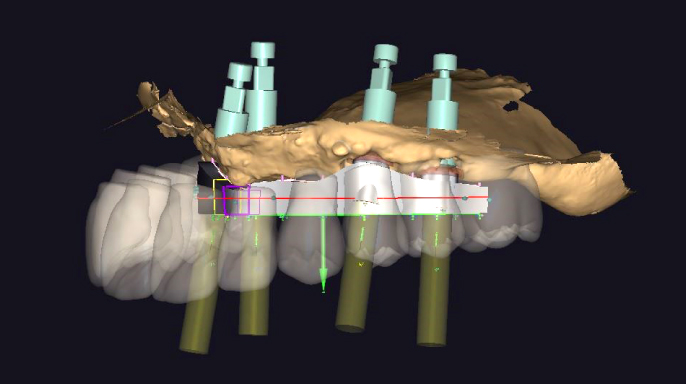 Rekonstrukce celkovou náhradou s ohledem na zachování implantátů 