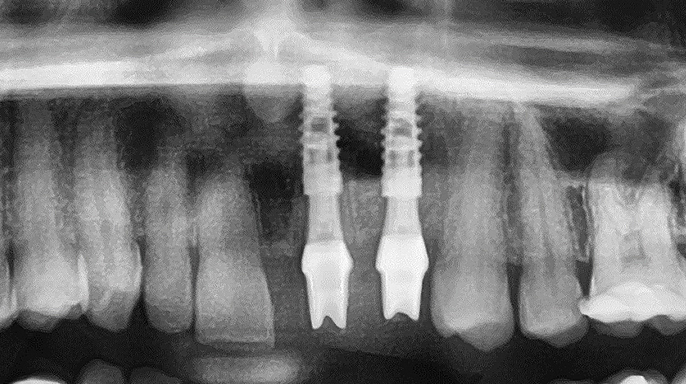 Fotokazuistika: okamžité zatížení implantátů