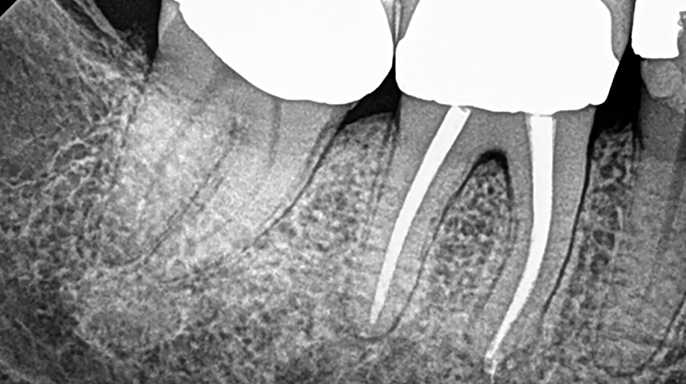 Reendodontické ošetření – úspěch s BioRoot Flow