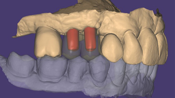 Jednoduše zhotovená náhrada nesená implantáty v éře 3D tisku Jednoduše zhotovená náhrada nesená implantáty v éře 3D tisku