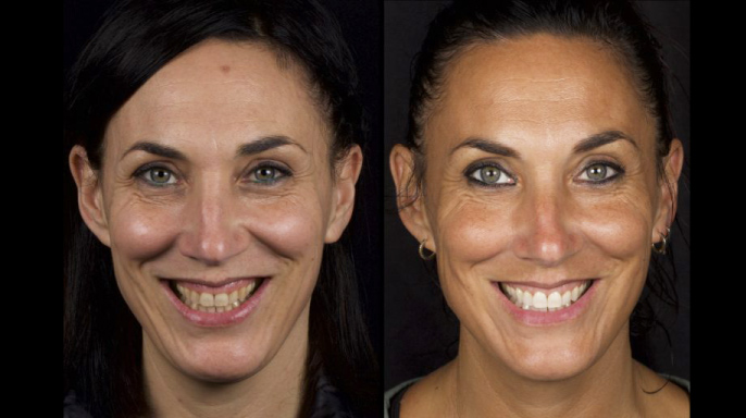 Digitální prodloužení korunky a domácí bělení zubů