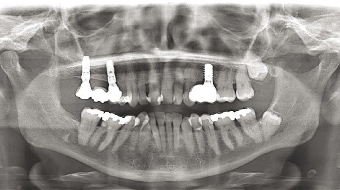 Implantologická rehabilitace u pacientů s aspergilovou sinusitidou