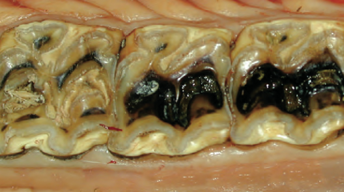 Restorativní ošetření infundibulárních kazů