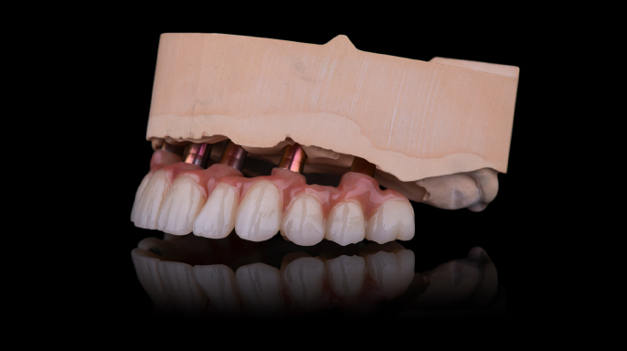 Implantáty nesená moderní komplexní rekonstrukce