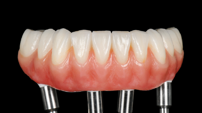 Celokeramické celkové náhrady na čtyřech implantátech