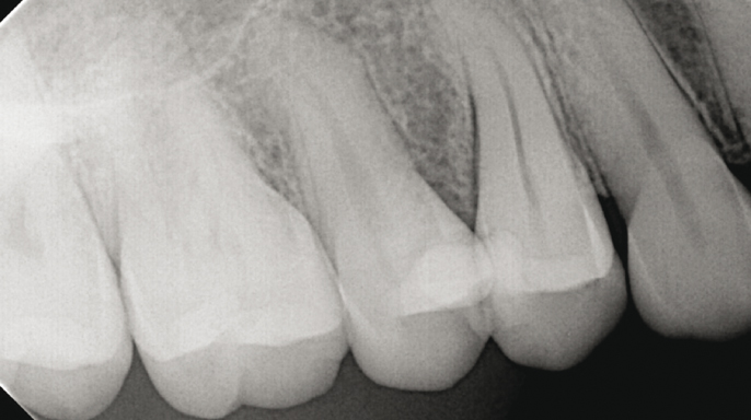 Jak diagnostikovat a endodonticky ošetřovat prasklé zuby