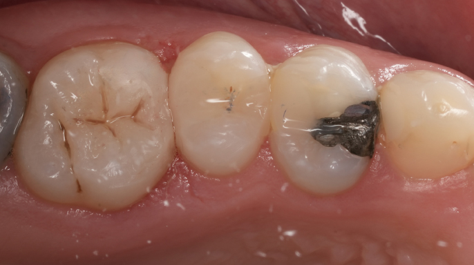 Inovativní dentální kompozitum: univerzální použití a zefektivnění výplňové terapie v klinické praxi