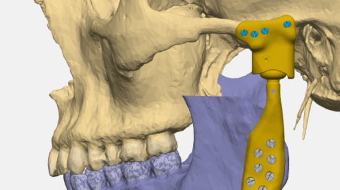 Má chirurgická léčba smysl? Aneb jaké je místo chirurgické terapie onemocnění čelistního kloubu v současnosti.