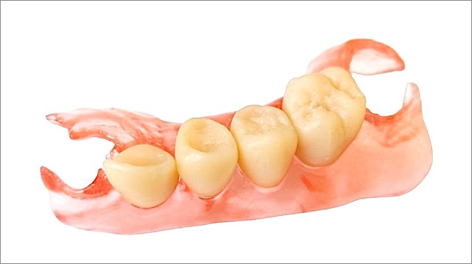 Mezerník Acetal a mezerník 3D tisk: nové možnosti snímatelných náhrad