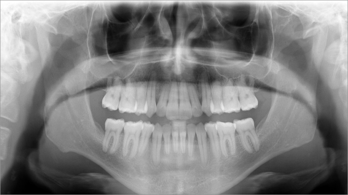 Léčba závažného frontálního otevřeného skusu pomocí průhledných alignerů Ordoline a mezičelistních elastických tahů III. třídy bez skeletálního kotvení
