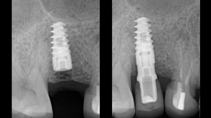 Preparace štoly pro implantát digitálním Er:YAG laserovým násadcem