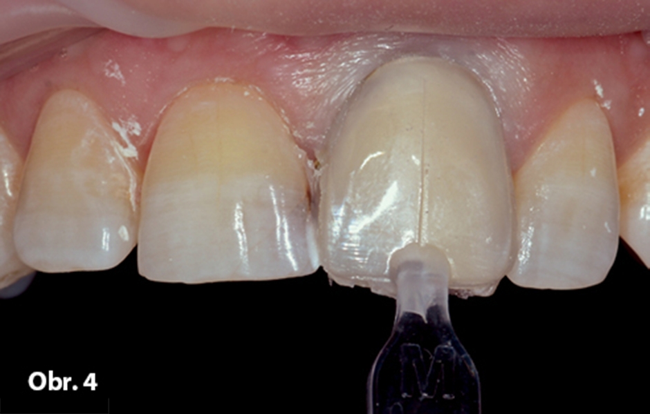 Obr. 4: Kompozitní materiál byl nanesen na preparovaný povrch zubu a do něj vtlačena šablona Uveneer, formující nový obrys labiální plochy. V případech, kdy šablona na zub perfektně dosedá a přesně kopíruje jeho kontury, zanechává po sobě hladký a lesklý 