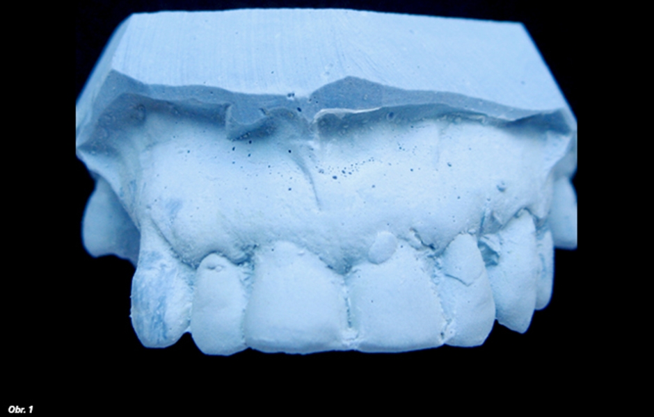 Výrazná disparalelita sponových zubů v laterálním úseku chrupu