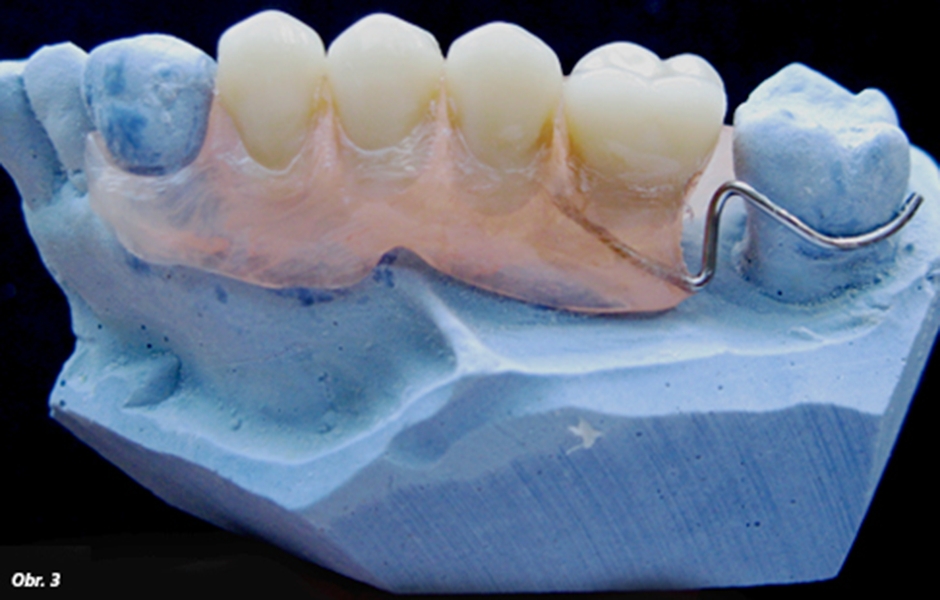 Disparalelní a parodontózní sponové kotevní zuby
