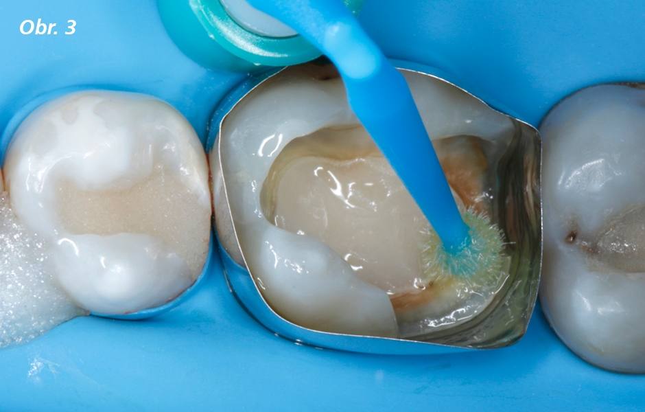 Adhezivní předošetření zubních tkání pomocí univerzálního adheziva Futurabond U (samoleptací)