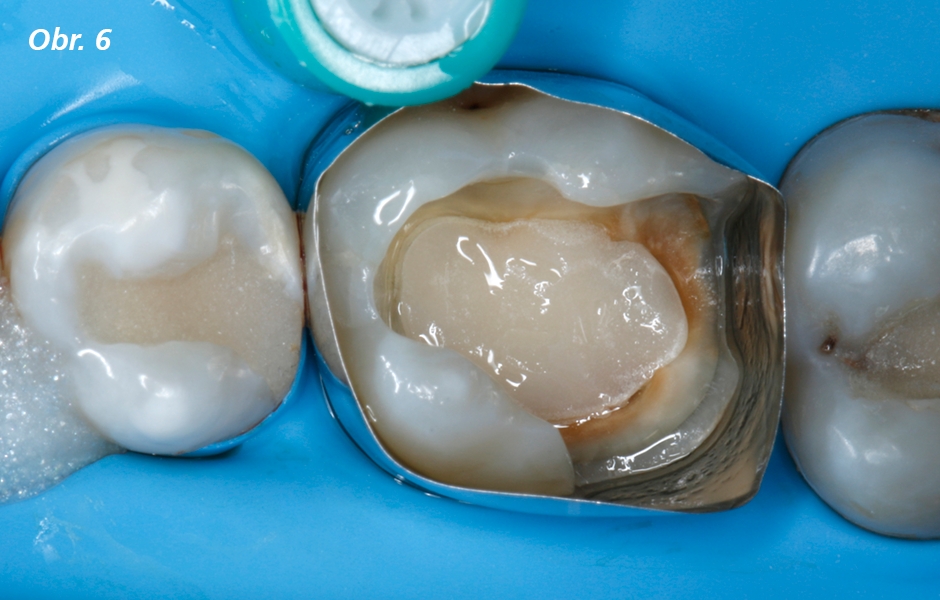 Lesklý povrch kavity znamená adhezivem rovnoměrně zapečetěný dentin a sklovinu