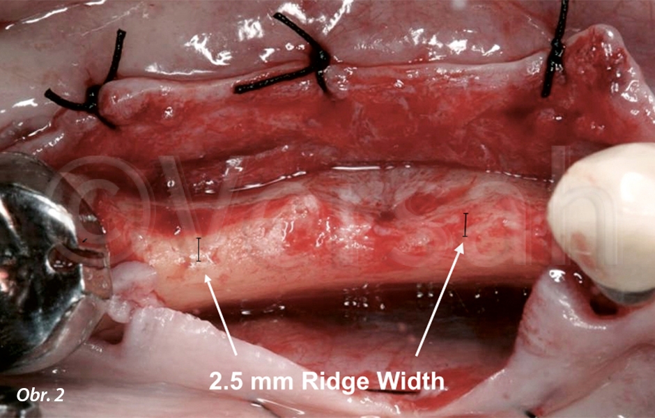 Odklopený mukoperiostální lalok odhalil výraznou resorpci alveolárního hřebene