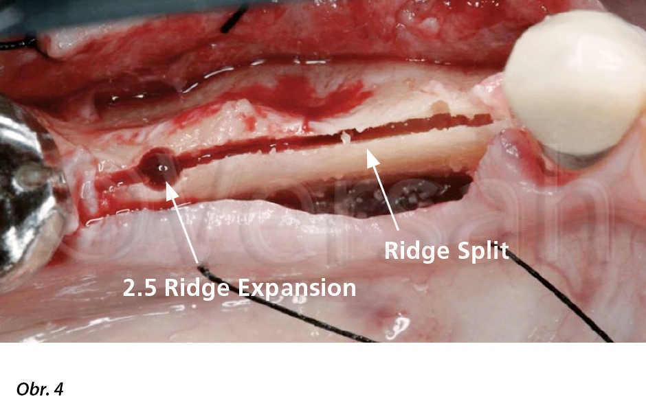 Expanze osteotomie na 2,5 mm byla vytvořena s použitím Densah™ Bur VT1525 poté, co bylo provedeno horizontální rozštěpení reliéfu hřebene