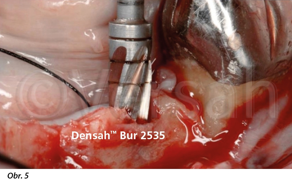 Densah™ Bur VT2535 byl použit v denzifikačním režimu pro expanzi a zhutnění oblasti budoucího implantátu v místě 36