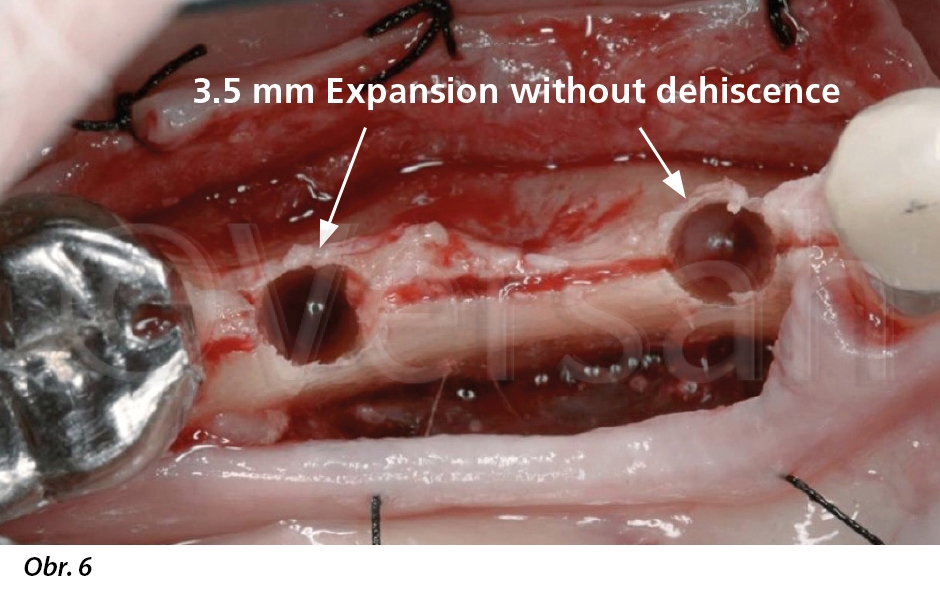 Oseodenzifikace usnadňuje expanzi osteotomie na 3,5 mm bez jakékoliv dehiscence kosti nebo fenestrace