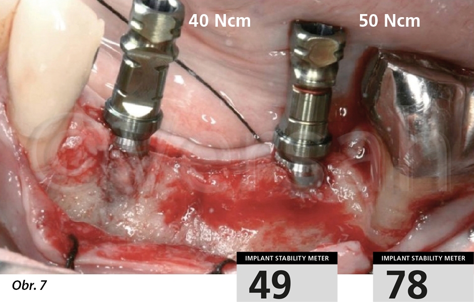 Implantáty zavedené do oblasti 36 a 34 s krouticím momentem 40–50 Ncm a hodnotou ISQ 49 a 78