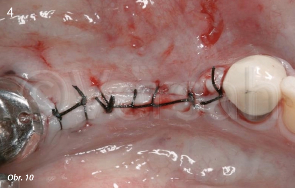 Překrytí lalokem a sutura