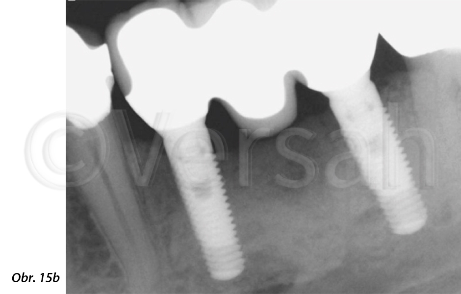 Kontrolní radiografické vyšetření po 1 roce ukázalo stabilní úroveň krestální kosti