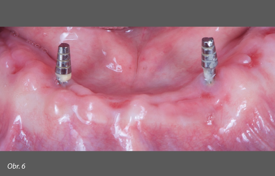 Zhojený alveol dolní čelisti se zavedenými provizorními implantáty
