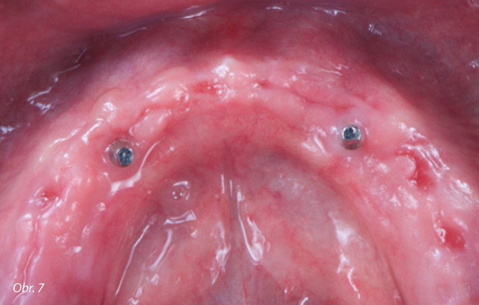 Zhojený alveol dolní čelisti se zavedenými provizorními implantáty