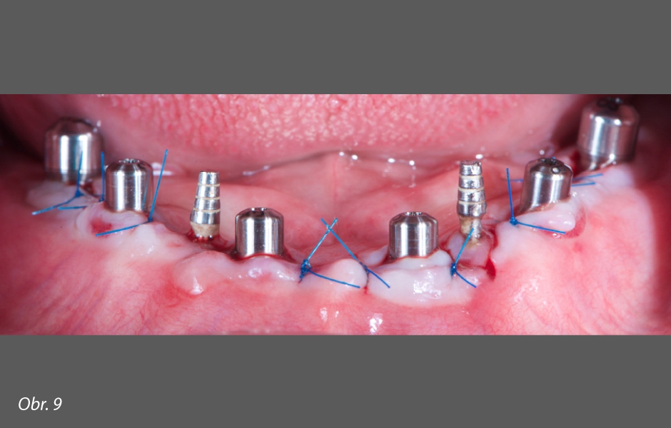 Zavedené definitivní implantáty s vhojovacími abutmenty