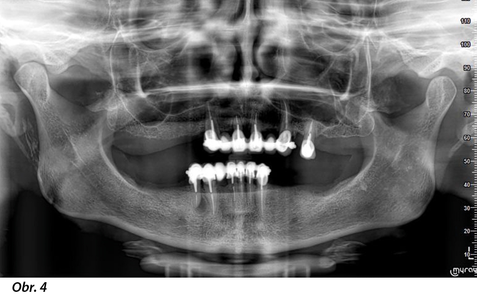 Digitálně zhotovená okamžitá celková fixní náhrada nesená implantáty Straumann® BLX ø 3,75, krátkými distálními implantáty