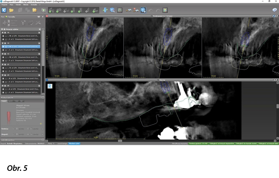 Digitálně zhotovená okamžitá celková fixní náhrada nesená implantáty Straumann® BLX ø 3,75, krátkými distálními implantáty