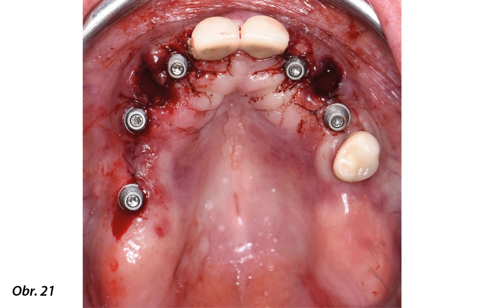 Digitálně zhotovená okamžitá celková fixní náhrada nesená implantáty Straumann® BLX ø 3,75, krátkými distálními implantáty