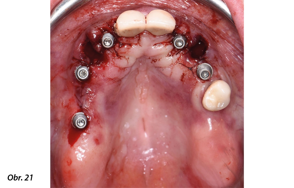 Digitálně zhotovená okamžitá celková fixní náhrada nesená implantáty Straumann® BLX ø 3,75, krátkými distálními implantáty