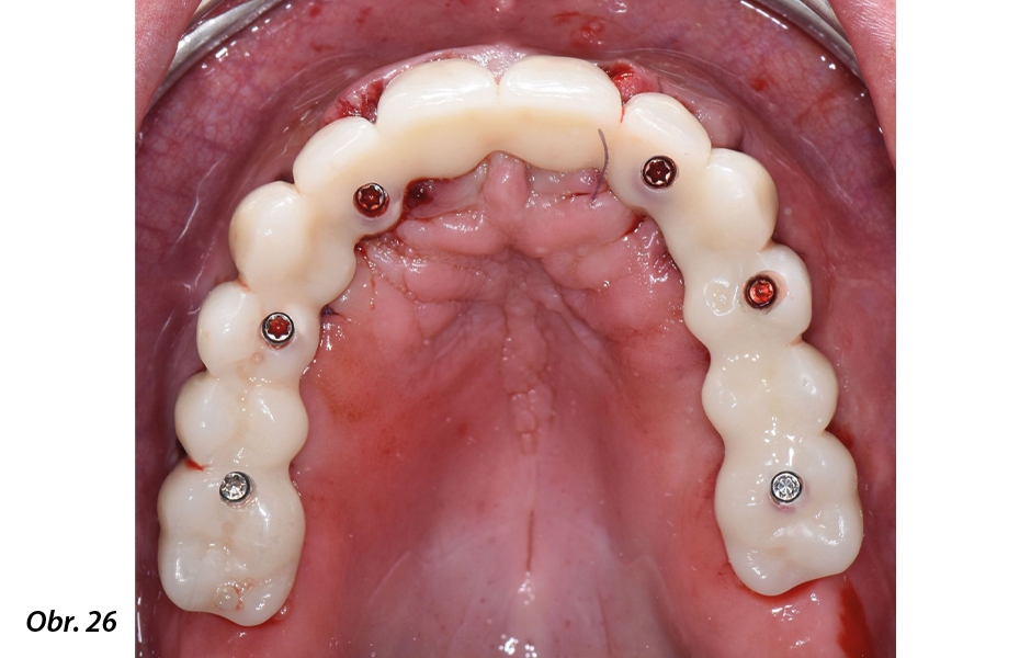 Digitálně zhotovená okamžitá celková fixní náhrada nesená implantáty Straumann® BLX ø 3,75, krátkými distálními implantáty